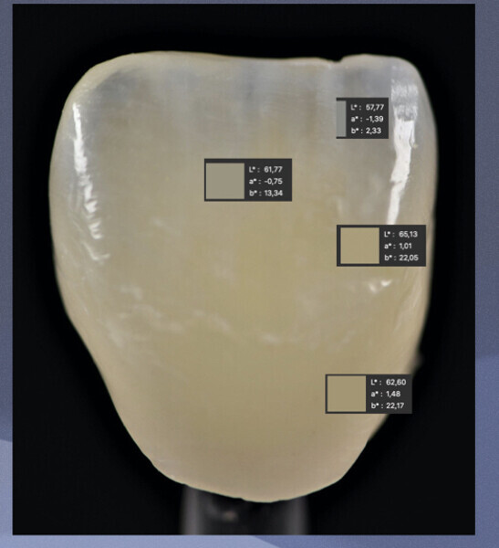 Fig. 18 : Contrôle final L.a.b d’une prothèse.