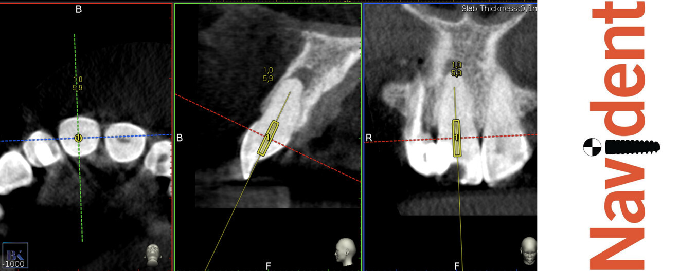 Figs. 3a–c: Planning of the virtual guide in Navident software (ClaroNav). The axis and depth of the preparation are shown.