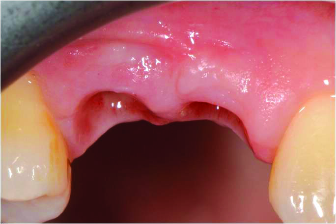 Figg. 9, 10_Dopo una fase di maturazione di 3 mesi, è stato osservato un significativo aumento del volume dei tessuti molli buccali e un miglioramento del deficit verticale dei tessuti molli.