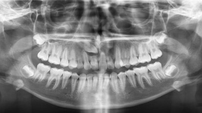 Preservación del tejido gingival en la rehabilitación implanto protésica postortodóncica
