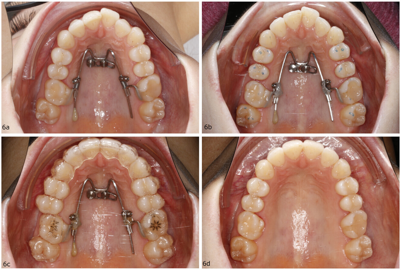 Figs. 6a–d: Treatment progress of a 25-year-old female patient with anterior crowding and incisor proclination. (a) Beneslider in place. (b) Situation after molar distalisation. (c) Subsequent aligner finishing. (d) Result.