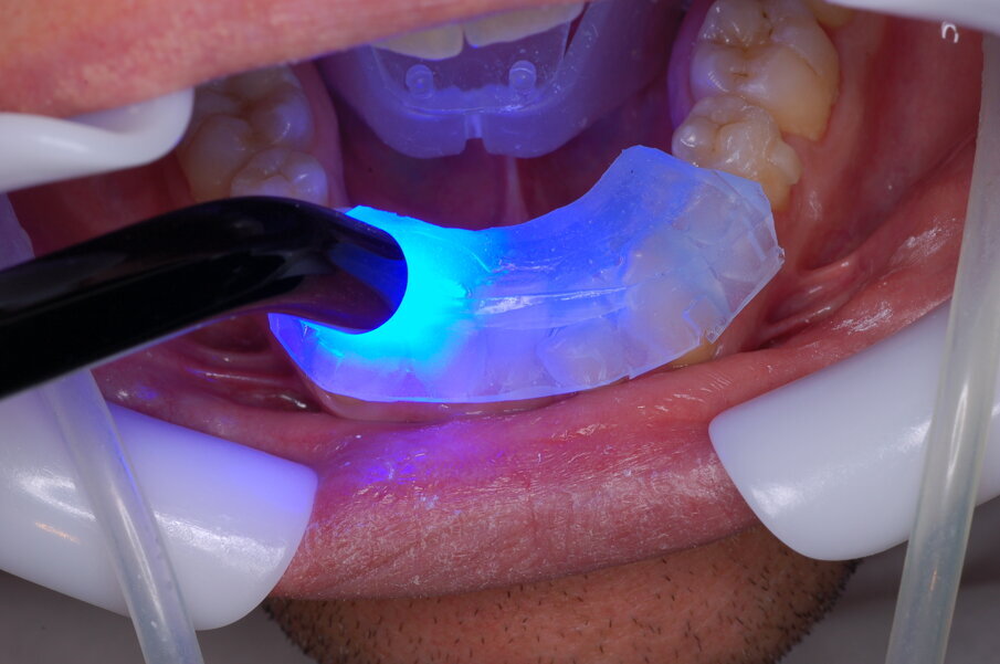 Fig. 31_Posizionamento del bracket linguale.