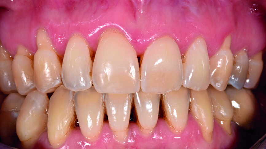 Fig. 17: Vue endo-buccale finale.