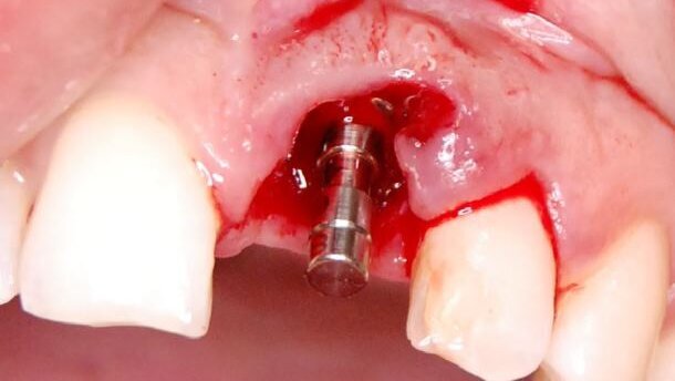 Implantacja natychmiastowa i kształtowanie estetyki różowo-białej – opis przypadku