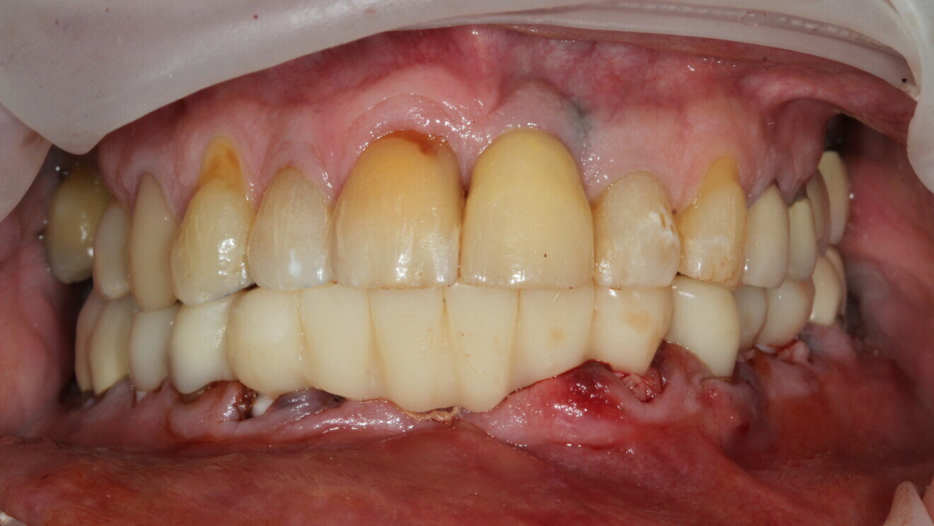 Fig. 9: Temporary restoration in situ.
