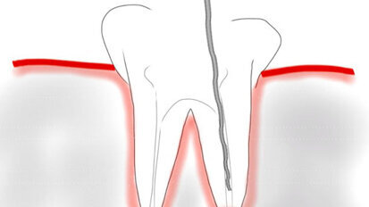 Ultrasoon reinigen zorgt voor schoner wortelkanaal