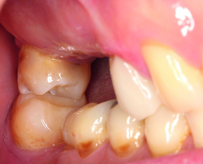 Figs. 1 et 2 : Situation intra-orale initiale. 