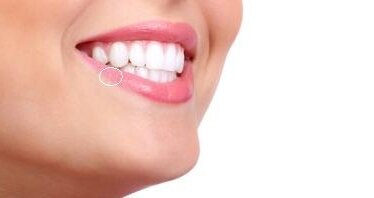 Wirus opryszczki może pomóc w leczeniu nowotworów jamy ustnej