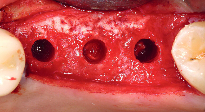 Figs. 10 et 11 : Application d’une membrane de collagène au-dessous de la membrane de Schneider
