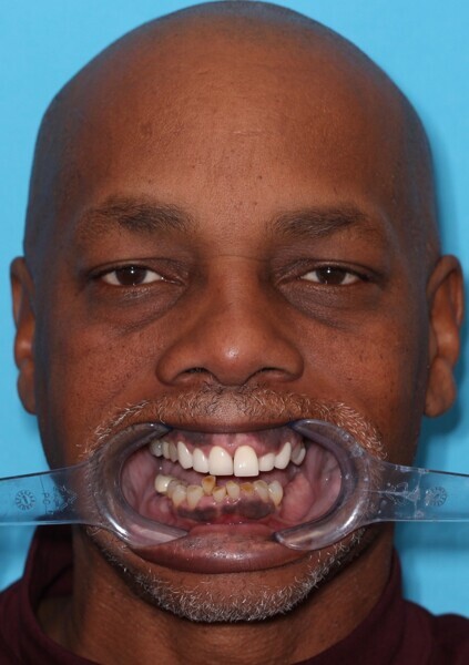 Fig. 3: Full-face retracted view of the patient, demonstrating functional and aesthetic challenges.