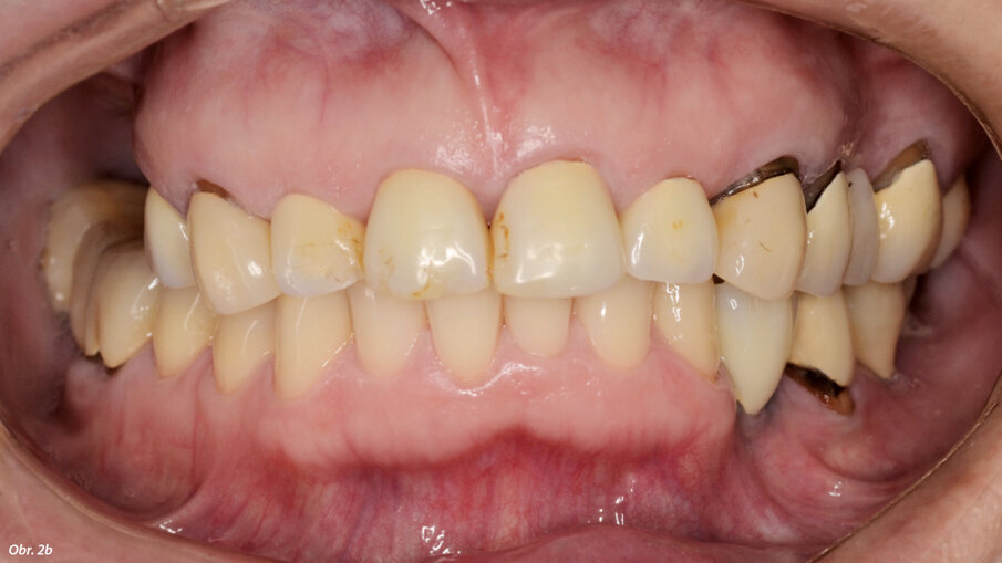 Výchozí situace se závažnou periimplantitidou.