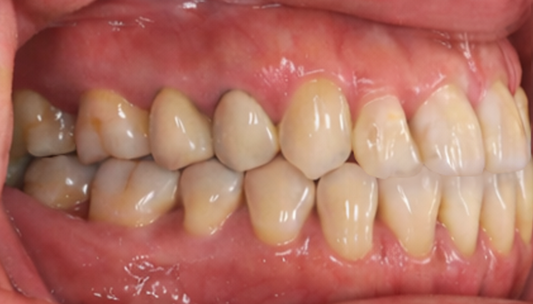 Figs. 12a–e: Final intra-oral photographs.