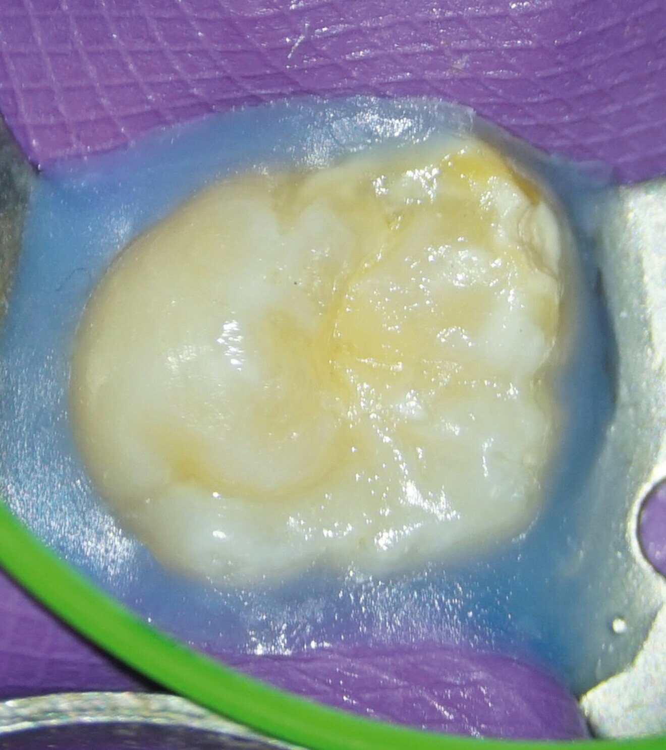 Fig. 10a : Restauration coronaire adhésive, juste avant le retrait de l’isolation. 