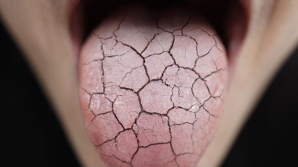 “We are thinking beyond dentistry”: Study helps clinicians identify Sjögren’s syndrome