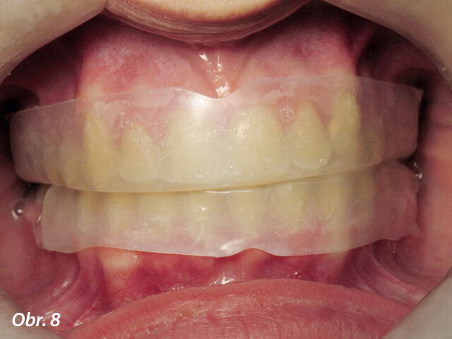Obr. 8: Univerzální nosič předplněný bělicím gelem na zubech.