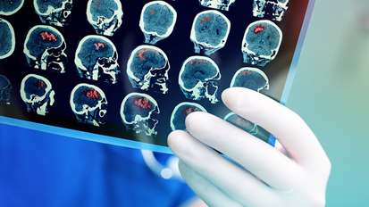 Schlechte Zahngesundheit birgt Risiko für Schlaganfälle Schlechte Zahngesundheit birgt Risiko für Schlaganfälle