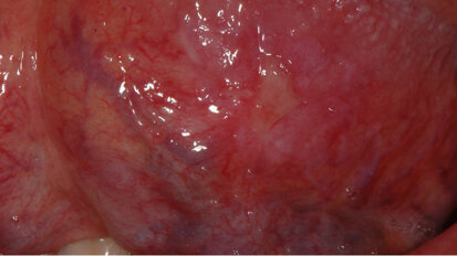 Prevenzione orale dei disordini potenzialmente maligni, uso della luce a fluorescenza