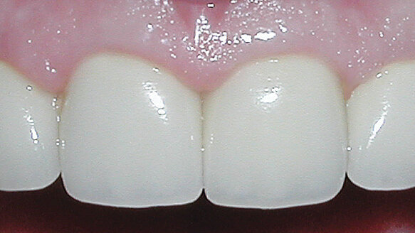 Clinical indications for a composite metal PFM restorative