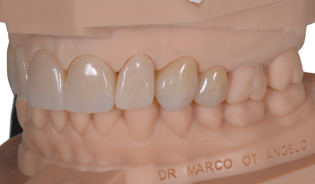 Fig. 18: Lateral view showing the crowns in the second quadrant.