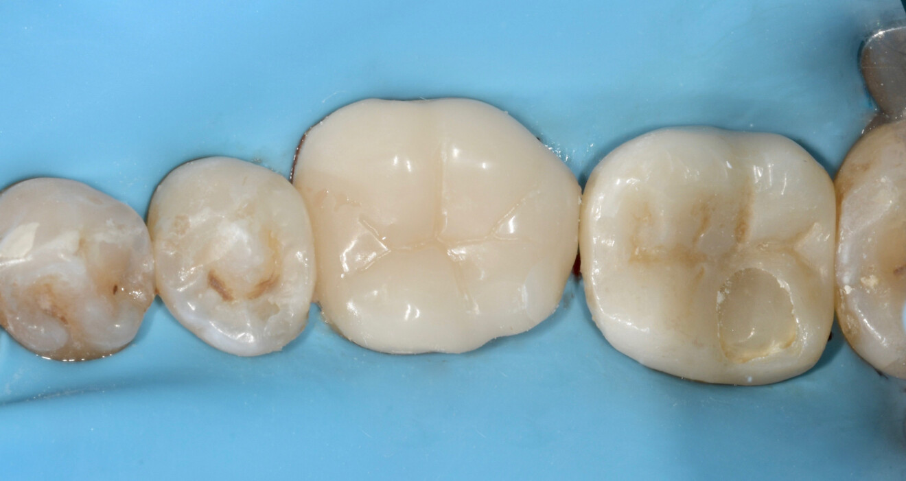 Fig. 24b: Endocrown after finishing and polishing under dental dam isolation.