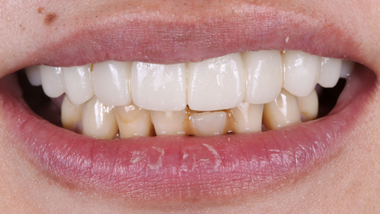 Fig. 6: Patient’s smile immediately after insertion of the conversion prosthesis.
