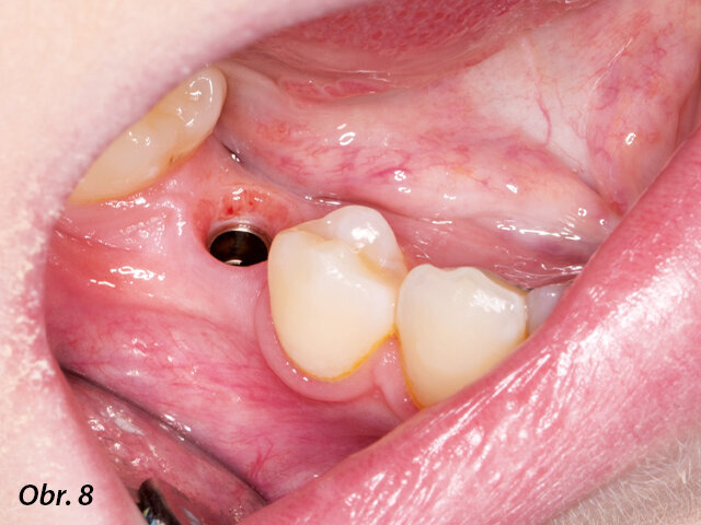 Za účelem navržení náhrady byl na implantát umístěn skenovací abutment.