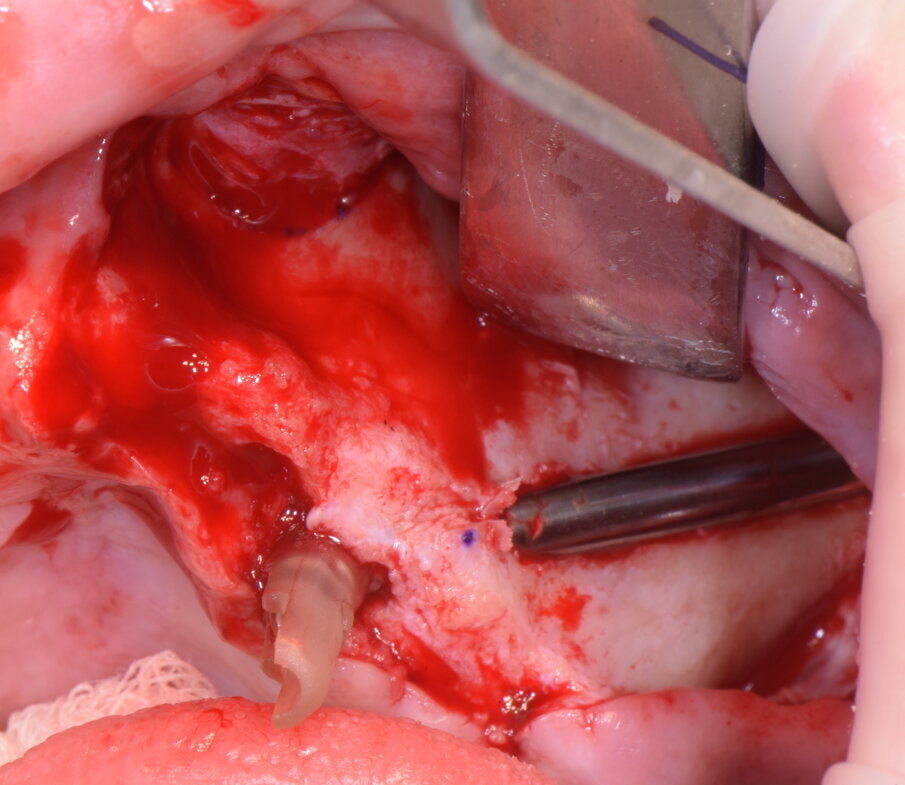 Figg. 20-23 - Impianto zigomatico AoN: notare la posizione extrasinusale con il mantenimento del picco osseo crestale.