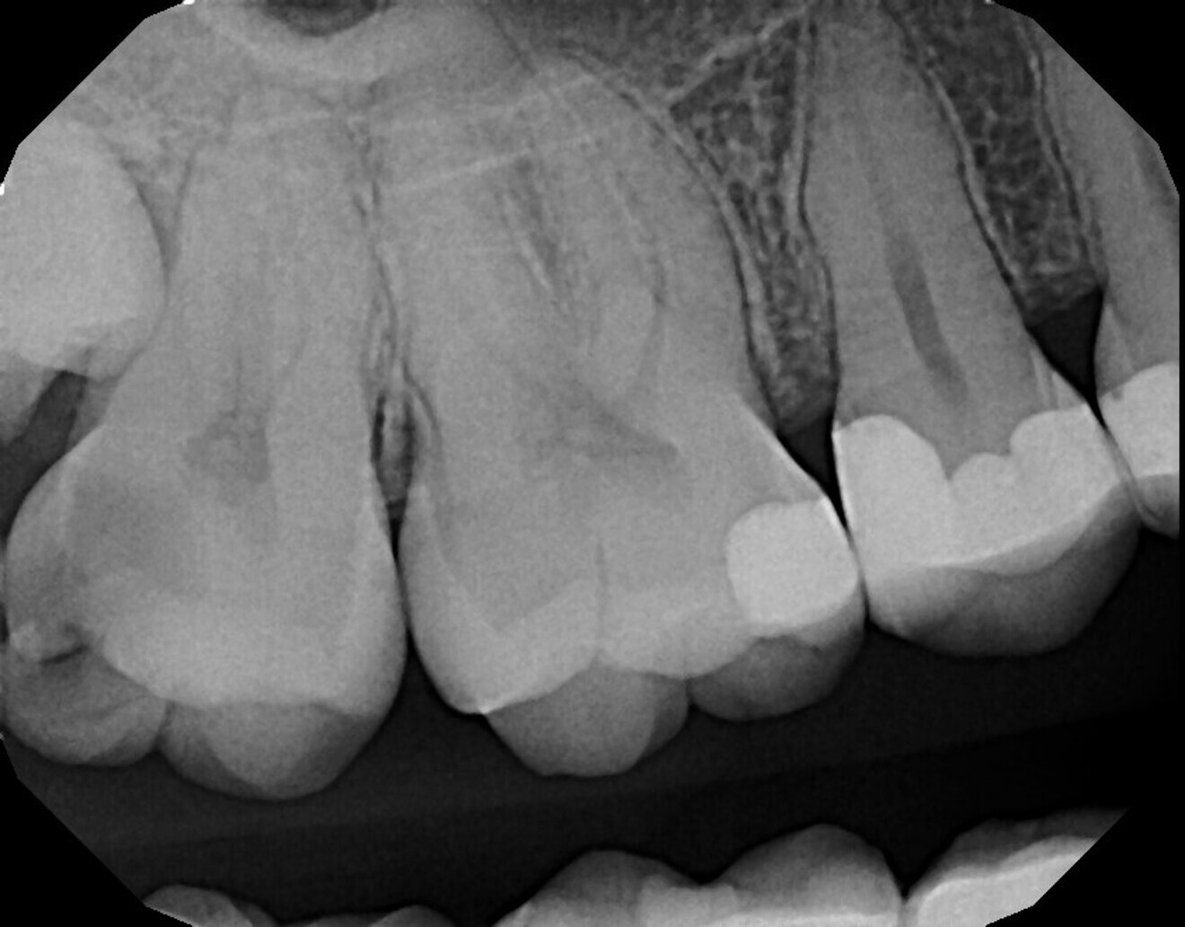 Fig. 10: Periapical radiograph taken preoperatively, demonstrating deep caries on the disto-occlusal aspect and minimal tooth substance over the pulp.