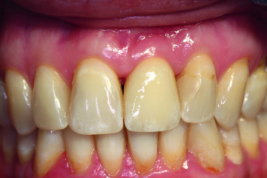 Fig. 12a: Clinical situation at the examinations after a) six and b) 12 months.
