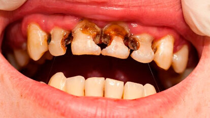 Individui con disturbi dei capelli possono essere più predisposti alla carie