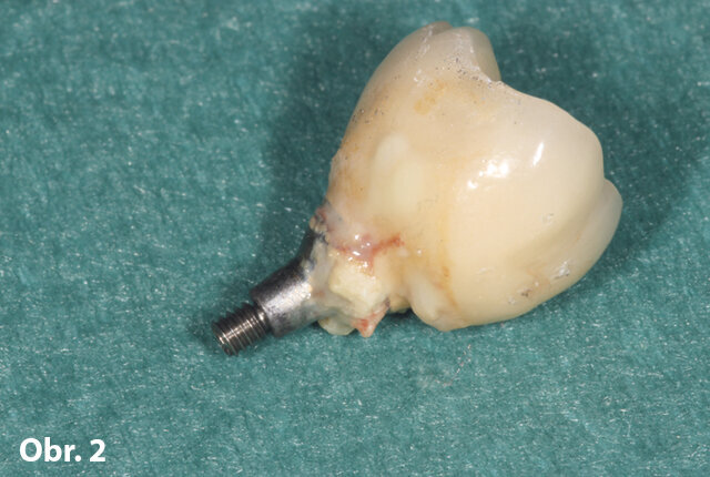 Špatně designované cementované náhrady