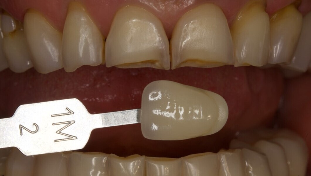 Fig. 3: Determination of the tooth colour using a shade guide.