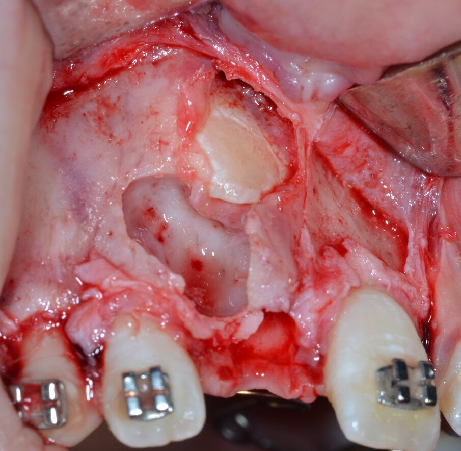 Fig. 15_Corona dentaria dell’elemento 1.1 correttamente esposta.