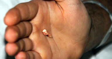 Burnundan Diş Çıktı! Burnundan Diş Çıktı!