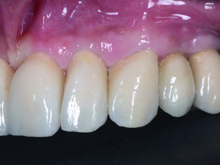 Fig. 17 : Vue détaillée postopératoire du côté gauche des couronnes unitaires en zircone cubique. 