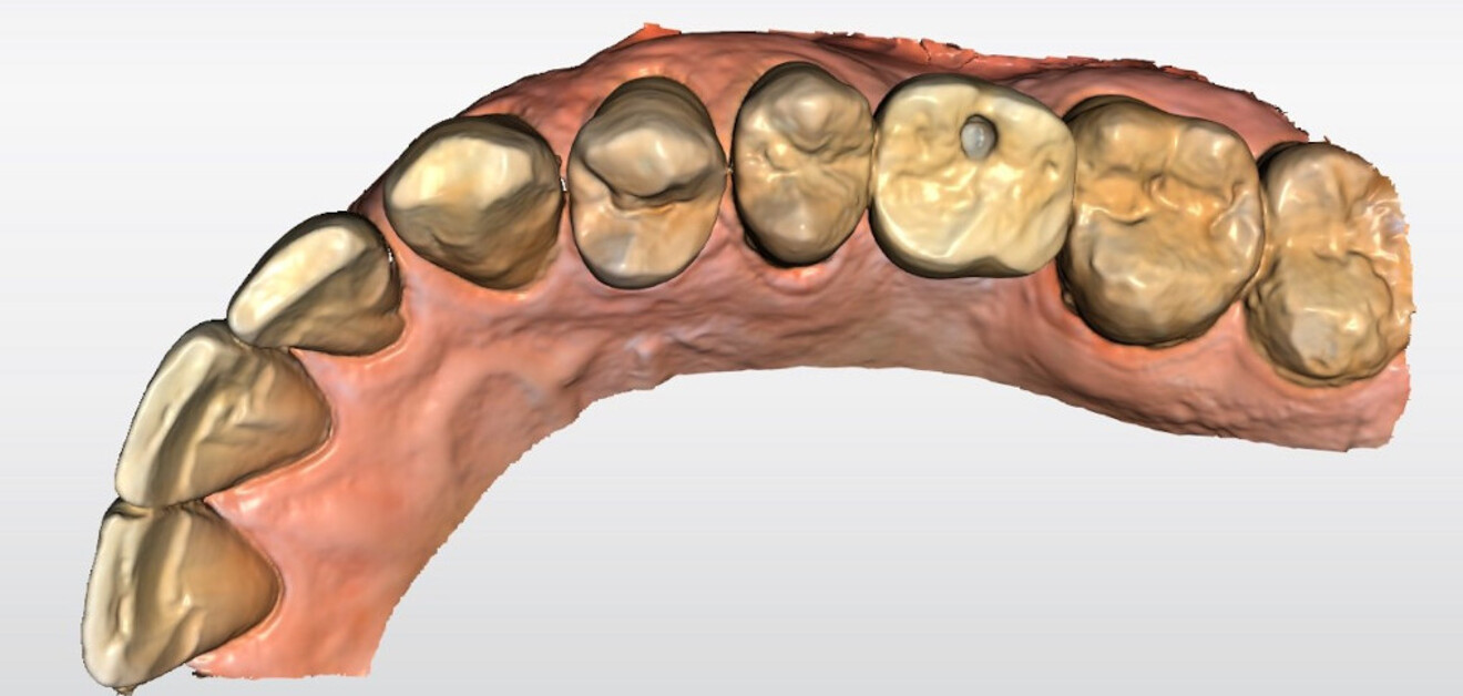 Fig. 15b: Initial intra-oral scans of the mandibular opposing quadrant.
