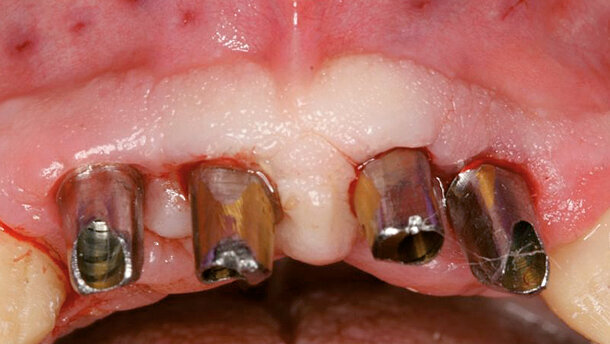 Massima estetica nel mascellare anteriore compromesso dal punto di vista parodontale: impianto immediato