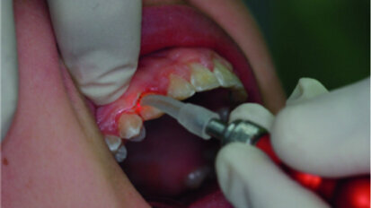 Surgical laser-assisted treatment via laser gingivectomy.