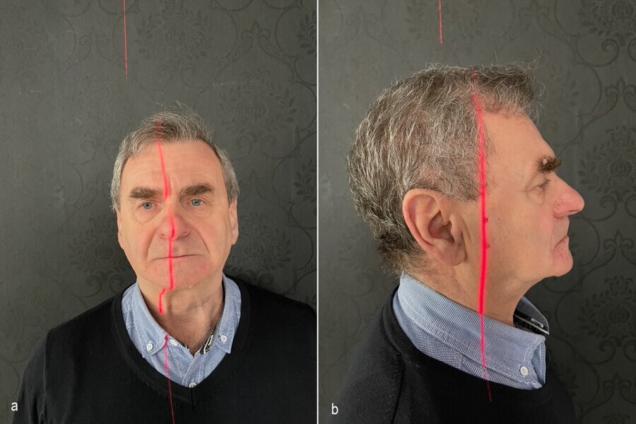 Figs. 1a & b: Surgical treatment planning: determination of the true vertical line.