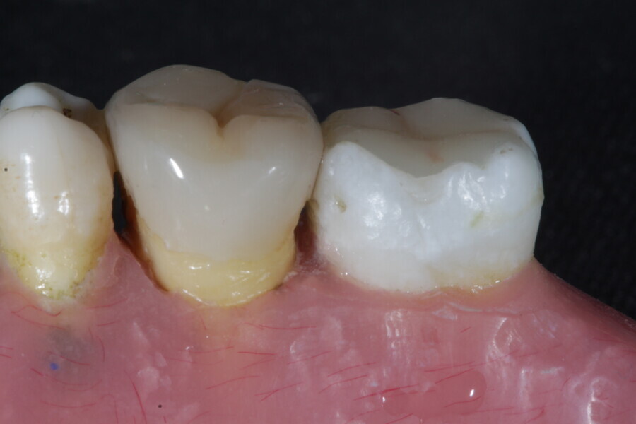 Fig. 44b: Restoration after finishing and polishing.