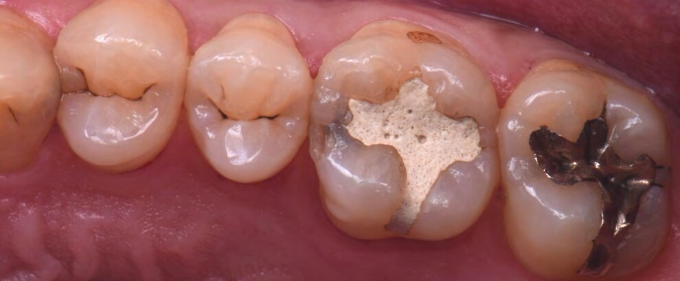 Fig. 1: Preoperative clinical presentation demonstrating multiple defective posterior restorations with fractured tooth structure and restoration failure prior to definitive adhesive rehabilitation.