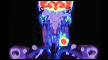 Нов трейсър помага да се избегне шийната дисекция при пациенти с рак в лицево-челюстната област