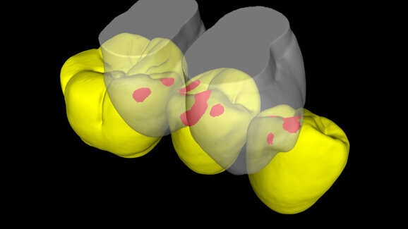 Zahnabnutzung Ursache für Zahnhalsdefekte