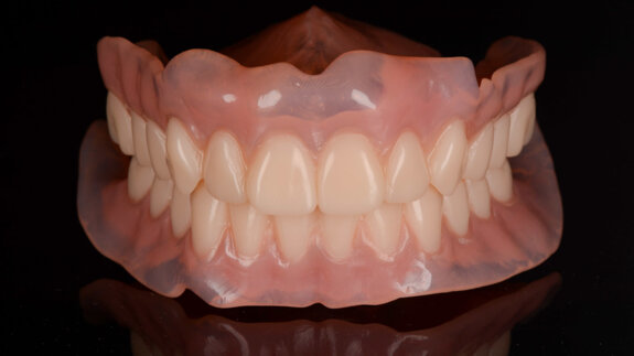 CAD/CAM complete dentures fabricated using additive and subtractive procedures