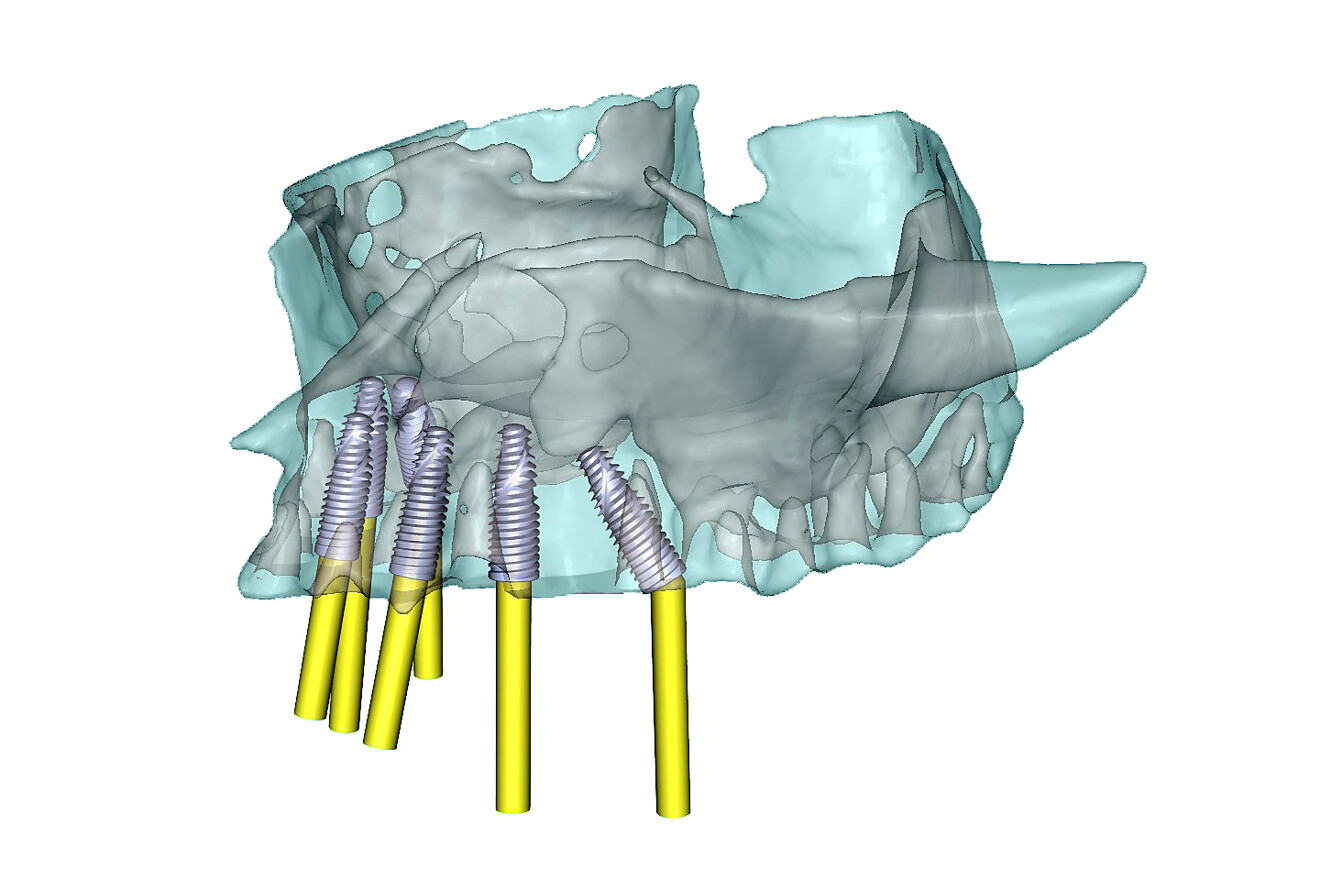 Fig. 3b: Selective transparency views of the simulated implants in the maxillary arch, including posterior tilted implants to avoid the maxillary sinus; left lateral view.
