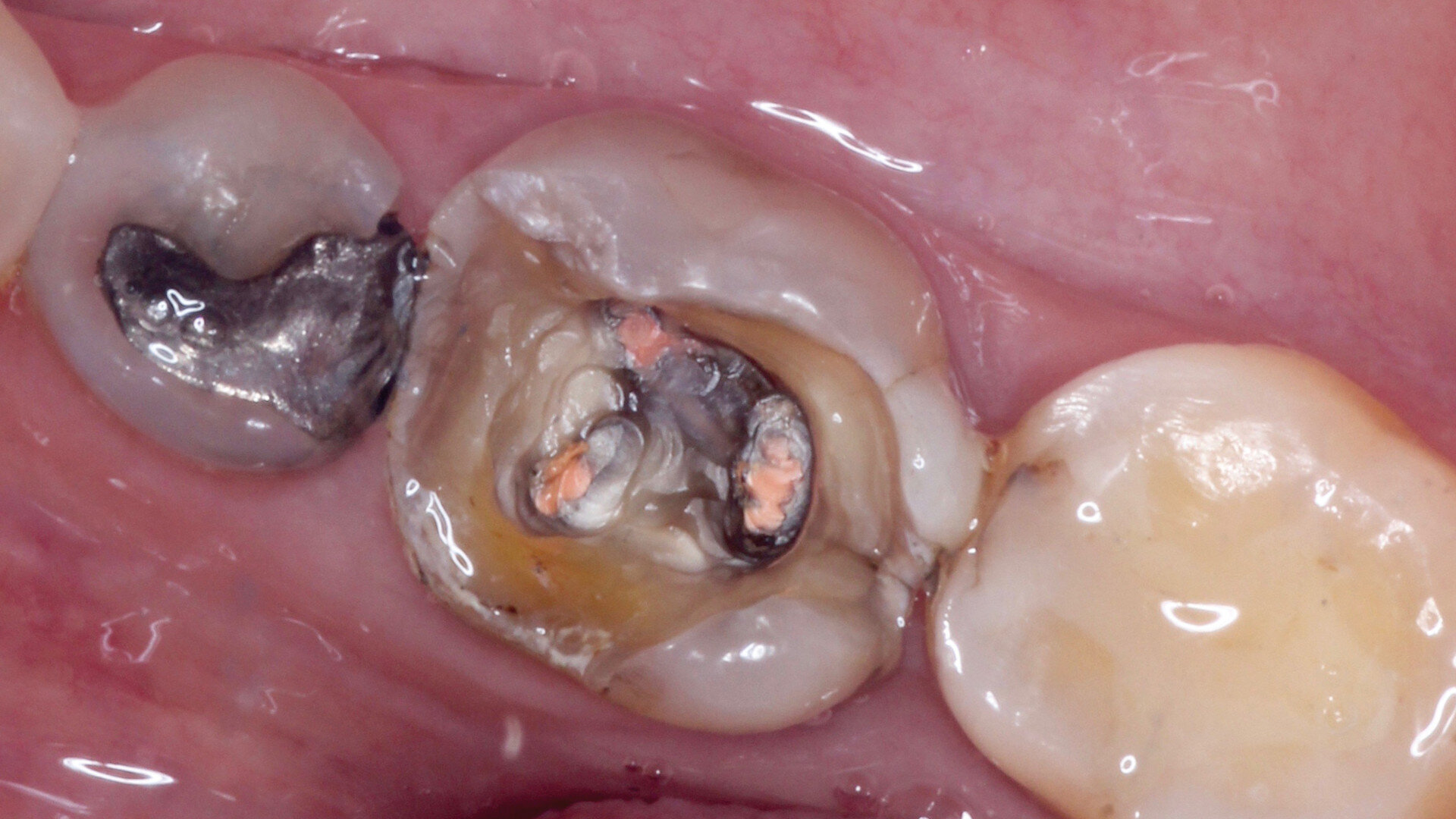 Endocrowns milled from CAD/CAM composites for high strength and flexibility