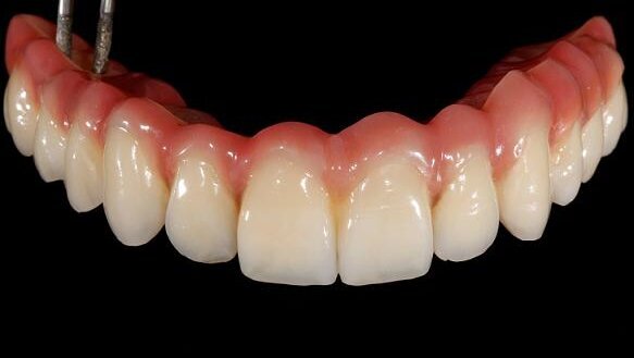 Full-arch reconstruction of the edentulous maxilla with the CAMLOG Guide System