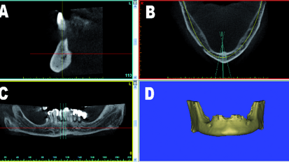3-D virtual planning concepts for implant-retained full-arch mandibular prostheses: The bone reduction guide