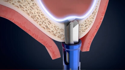 Osstem Implant announces call for abstracts for London event—and CAS-KIT prize Osstem Implant announces call for abstracts for London event—and CAS-KIT prize