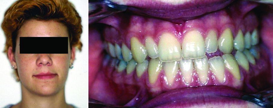 Figure 3. Facial photograph of a 16-year-old girl with heminandibular hyperplasia (right side). The discrepancies include asymmetries in the mandibular body, ramus, and condyle (a). Malocclusion is characterized by left anterior crossbite and lower dental midline deviation to the non-affected side (b). 